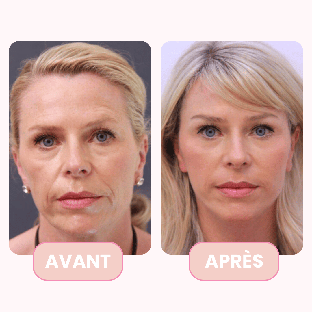 ReviveMask au PDRN – Soin anti-imperfections